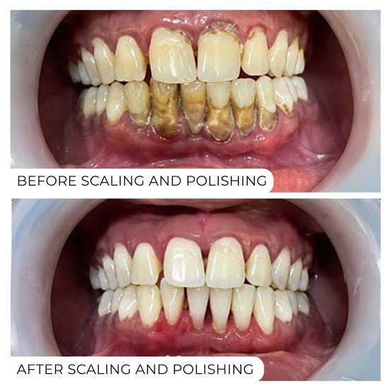 Real patient: teeth before and after scaling and polishing